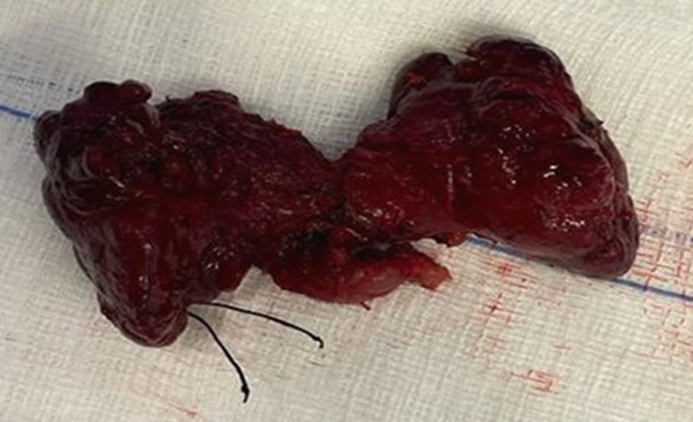 Thyroid gland after thyroidectomy.