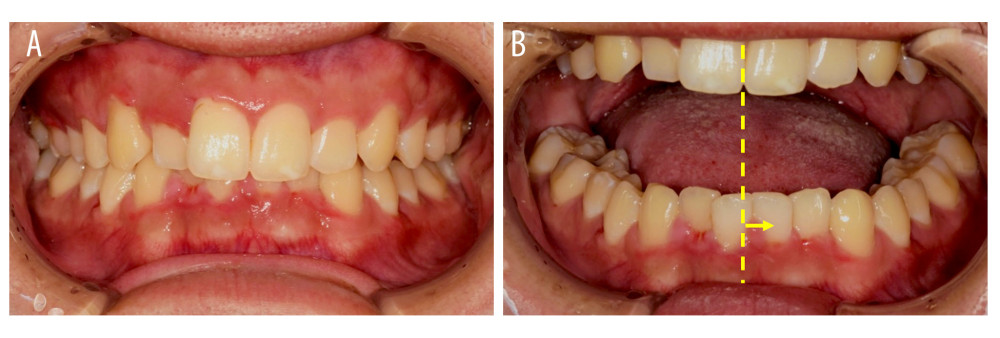 Intraoral findings. (A) No deviation in occlusion. (B) Picture at the opening of the mouth. The midline of the mandible was slightly displaced to the left (arrow). Dotted line: midline of the mandible.