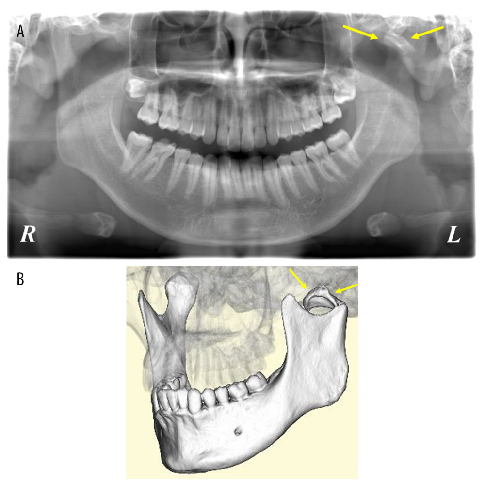 X-rays at the first visit. (A) Dental panoramic tomography. (B) Dental cone-beam computed tomography. 3D surface rendering. The condyle neck fracture and deviation of the condyle head forward, inward, and downward, were confirmed. Arrows indicate the deviated condyle head.