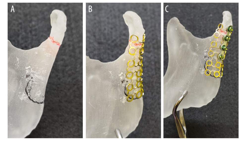 Pictures of 3D model and preparing the custom-made titanium mesh and miniplate. (A) Repositioning the condyle. Red line indicates fracture region. (B) Adjusting the titanium mesh. (C) A miniplate was added to posterior margin of ramus.