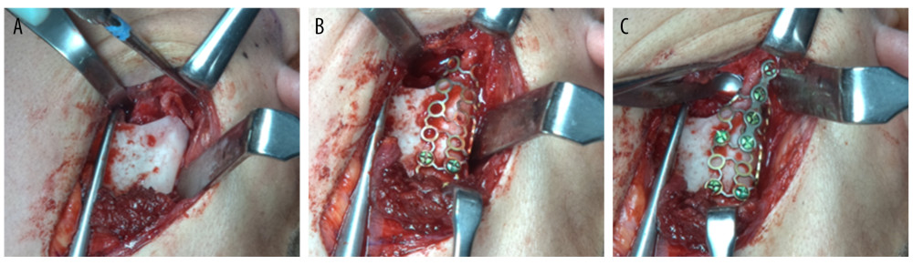 Pictures during operation. (A) The fracture region is exposed. (B) The condyle fragment is repositioned and gripped by a custom-made titanium mesh with a mandible fragment. (C) A miniplate is placed closer to the posterior margin and 7 screws are used for fixation.