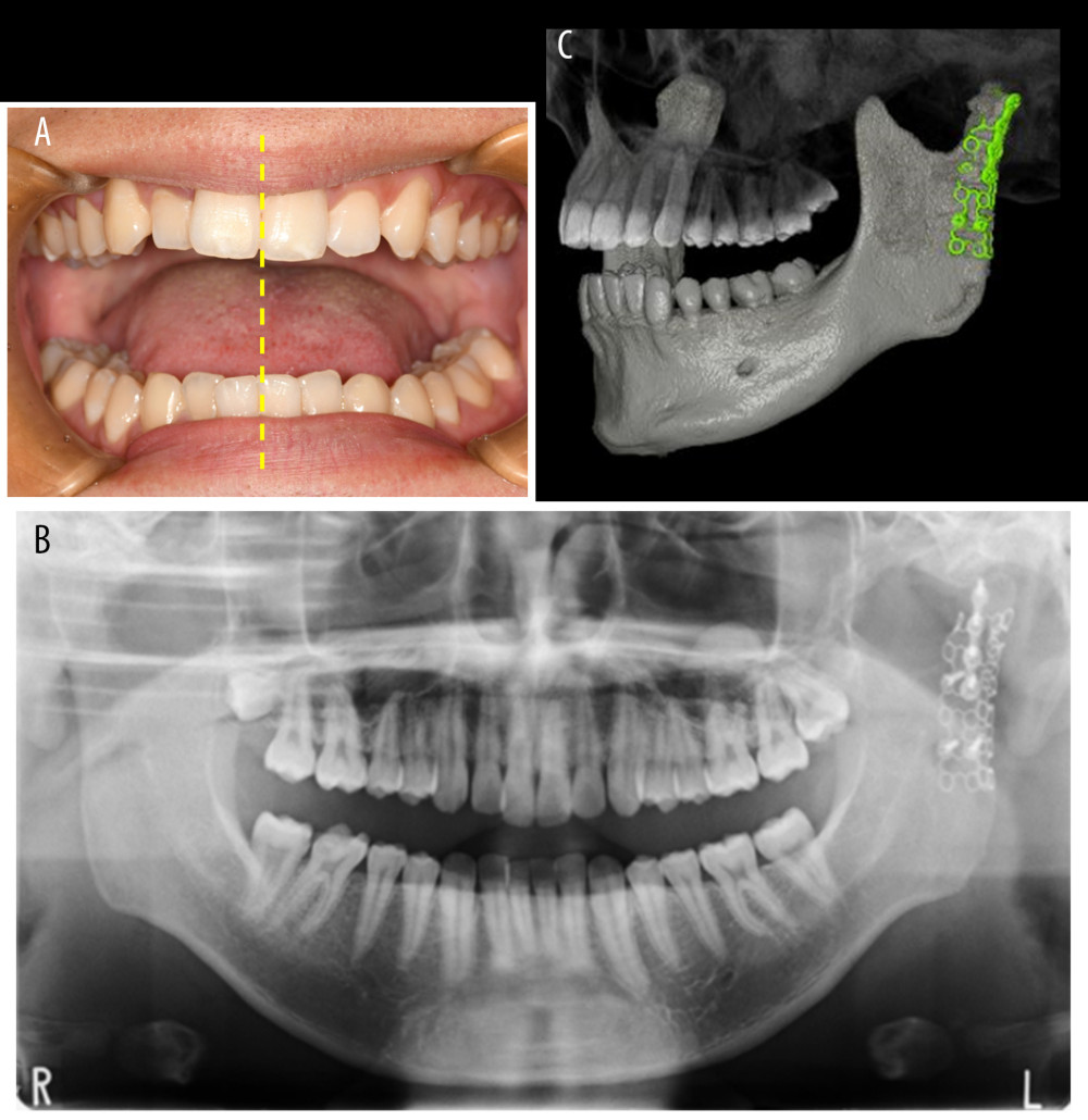 Pictures 9 months after the operation. (A) Picture the opening of the mouth showing that there is no deviation. (B) Dental panoramic tomography. (C) Dental cone-beam computed tomography. 3D surface rendering. Although there is slight absorption on the condylar surface, the condyle is repositioned and stable.