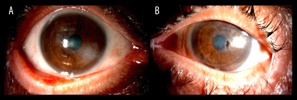 (A) Slit-lamp clinical photo of the right eye showing severe ocular surface disease. (B) Slit-lamp clinical photo of the left eye showing a paracentral, punched out, sterile corneal perforation.