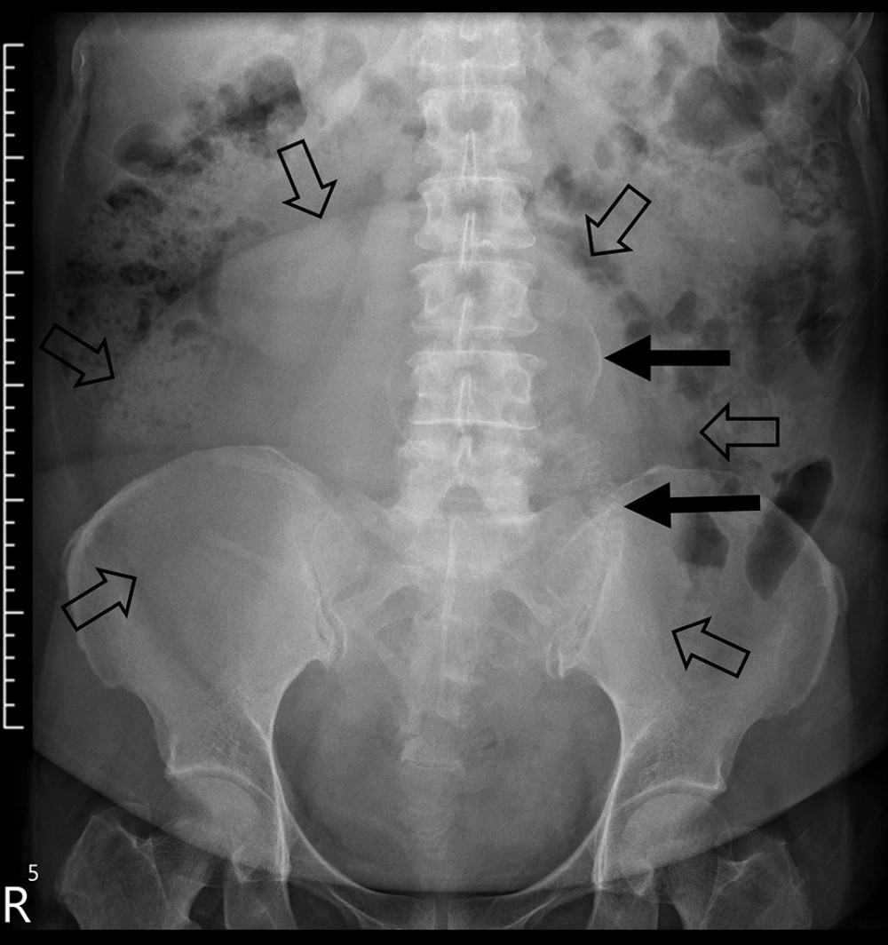 Abdominal radiography revealing a large mass (white arrows) with calcifications (black arrows) in the pelvis and lower abdomen. Each unit on the scale represents 1 cm.