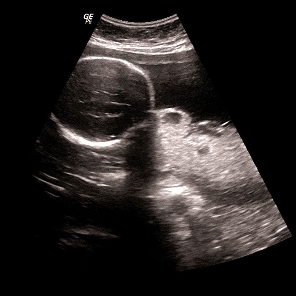 Abdominal ultrasound revealing a fetus inside the uterus. According to ultrasound measurements, the gestational age was estimated to be approximately 26 weeks and 4 days, and the estimated fetal weight was 960.87 g.
