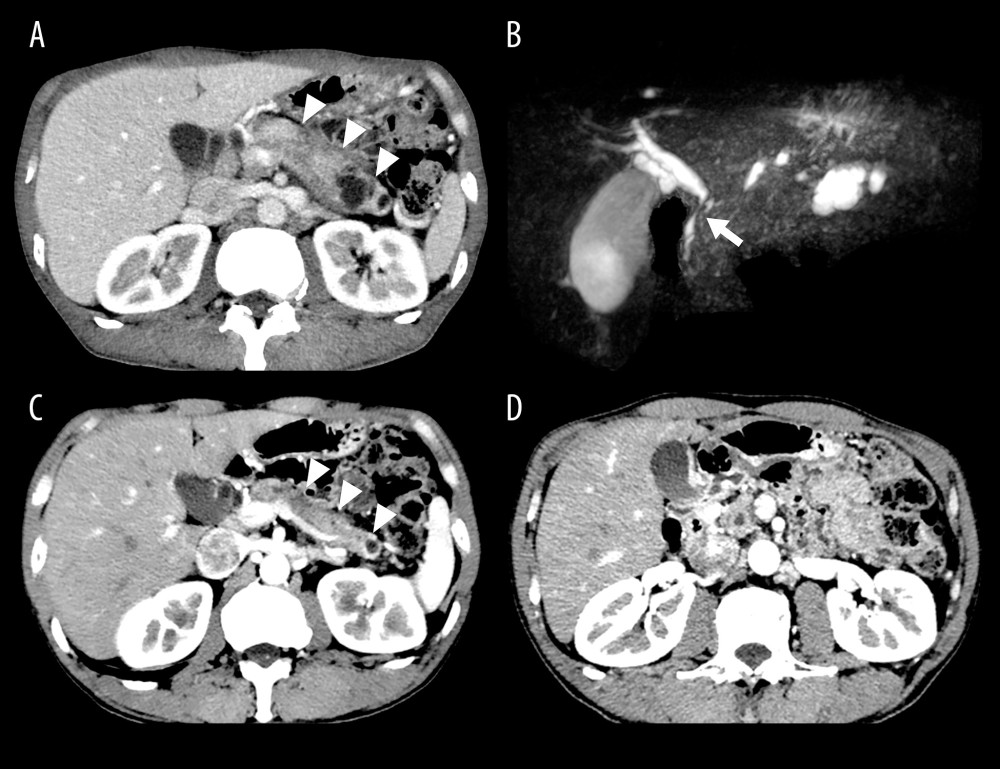 Computed tomography images of the pancreas and kidneys, as well as magnetic resonance cholangial pancreatography. (A) Pancreatic enlargement and (B) bile duct stenosis before treatment for autoimmune pancreatitis are shown. (C) The atrophic pancreas after treatment is shown. Arrowheads indicate the pancreas; arrows indicate the site of bile duct stenosis. (D) Abdominal computed tomography shows no abnormalities in the kidneys.