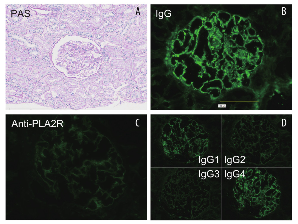 Pathological findings of the renal biopsy. The histopathological findings of the renal biopsy are shown. The tubulointerstitium and glomeruli appear normal on light microscopy. (A) Periodic acid-Schiff (PAS) staining. (B) Immunofluorescent staining for immunoglobulin G (IgG) reveals global granular glomerular basement membrane staining. (C) Immunostaining for anti-phospholipase A2 receptor (PLA2R) antibody reveals negative staining of the glomeruli. (D) Immunostaining results for the IgG4 subclass are shown. Staining for IgG2 and IgG3 was negative, whereas that for IgG1 and IgG4 was positive. Notably, strong staining was observed for IgG4.