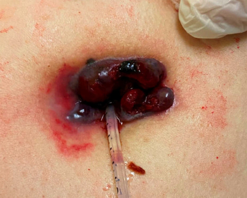 Dermatologic findings of the gastrostomy tube site in the right upper quadrant of the abdomen. The gastrostomy tube has been removed and stented open with a catheter. The black discoloration and mild hemorrhage were concerning for necrosis.