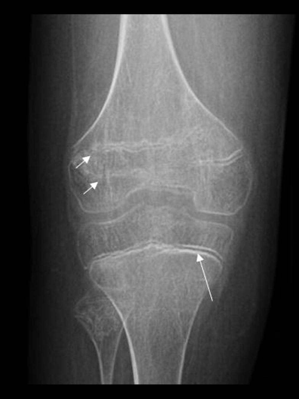 Anterior-posterior right knee radiograph demonstrating diffuse osteopenia. There is increased density at the zone of provisional calcification compatible with a Frankel’s line as seen in scurvy (thin arrow) [4]. The distal femoral growth plate is distorted and irregular, producing doubled appearance related to different heights of the posterior and anterior physis (short arrows). The patient is status post hardware removal. Plain films commonly show osteopenia, though this is nonspecific [4,9], as well as thin cortex, signs of subperiosteal fluid (if it ossifies, representing edema or hemorrhage), and microfractures [1,4,9]. The most specific findings include the white line of Frankel (a thickened and irregular calcification at the metaphysis), and the Trummerfeld zone (zone of lucency on the diaphyseal side of the line of Frankel), which is a late finding [2–5,9]. Pelkan spurs (healing metaphyseal fractures) and Wimberger rings (thin and sclerotic cortex surrounding a lucent epiphysis) are also classic to scurvy [3–5]. While specific, these findings are not sensitive and are often either absent or overlooked.