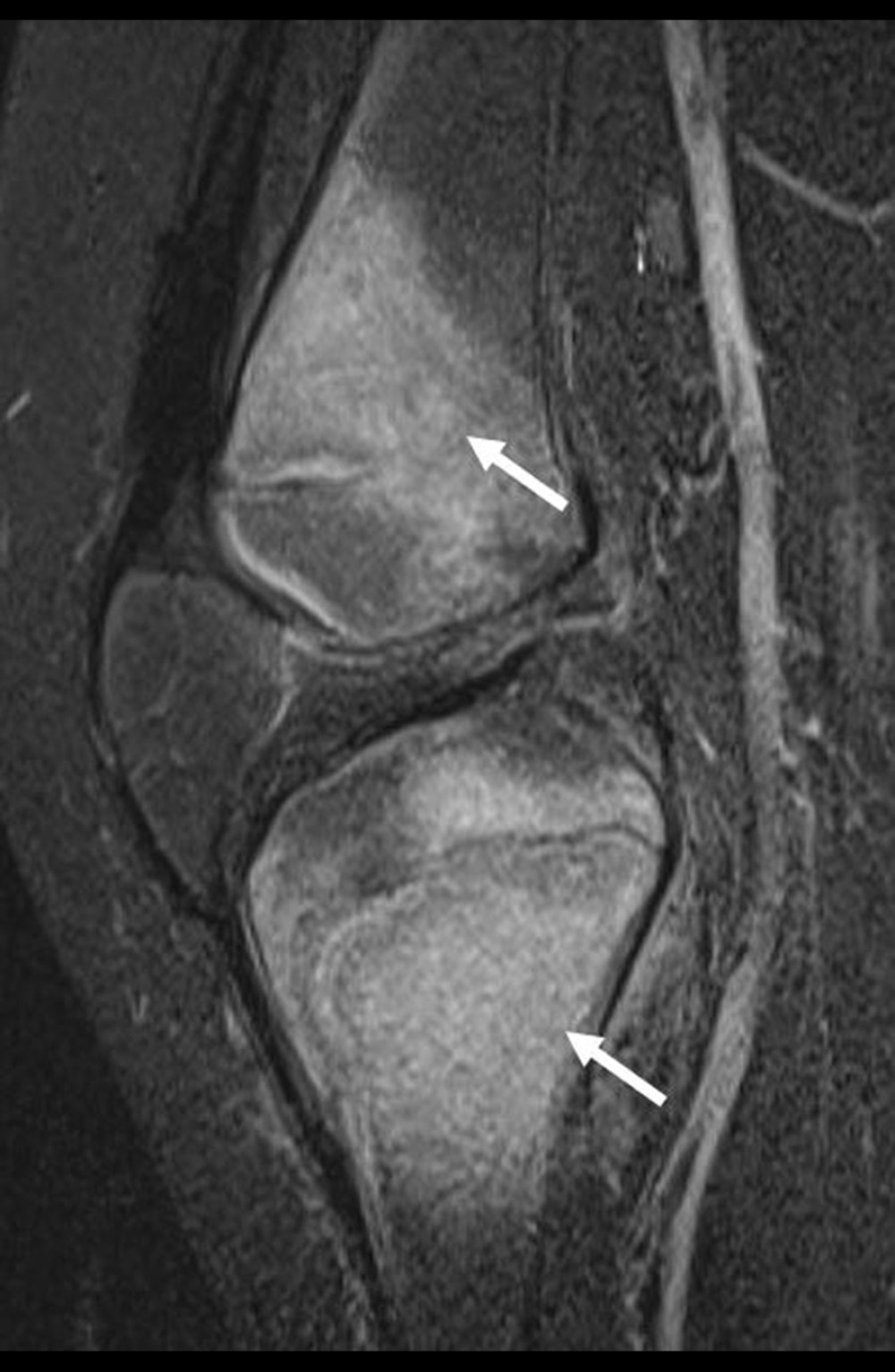 Sagittal short tau inversion recovery image of the right knee demonstrating regional areas of T2 hyperintense signal centered in the distal femoral metaphysis and proximal tibial metaphysis, compatible with the MRI findings of scurvy (arrows) [4,24]. The lack of knee joint effusion, intra-osseous or subperiosteal abscess, argues against osteomyelitis and septic joint. Additionally, osteomyelitis is unlikely to affect the femoral and tibial metaphyses with relative sparing of the epiphyses and without intervening joint effusion [2,4,24]. MRI demonstrates a predictable pattern in scurvy, with symmetric areas of T2 hyperintensity and enhancement predominately in the long-bone metaphyses [2,4,5,24]. Subperiosteal fluid and soft-tissue edema may also be seen [4,24].