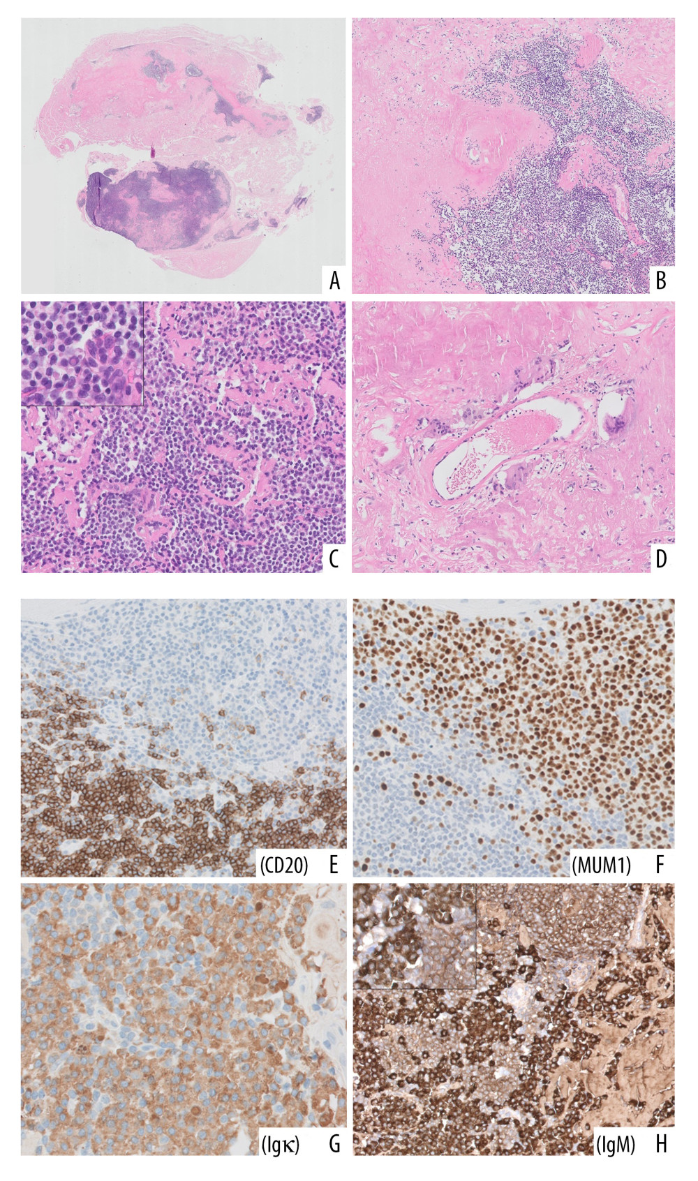 Histological and immunohistochemical features of the first excised subcutaneous lesion showing the LPL-associated amyloidoma. At low power, the abundant amorphous, glassy pink material permeating the fibro-fatty subcutaneous tissue is readily appreciable (A: Hematoxylin and eosin (H&E) ×20) and it appears intimately admixed with a patchy cellular infiltrate (B: H&E ×50). A higher-power view (C: H&E ×200) allows identification of a mixed population of small lymphocytes, plasma cells, and plasmacytoid lymphocytes, with numerous Dutcher bodies (inset: ×600). Peripherally, one can also notice multinucleated giant cells of foreign body type surrounding thin-walled vessels (D: H&E ×100). Immunohistochemical (IHC) studies confirm the presence of a dual population of small CD20+ B lymphocytes (E: CD20 IHC ×200) and MUM1+ plasmacytic-differentiated elements (F: MUM1 IHC ×200). The whole lymphoplasmacytic population shows Ig κ light-chain restriction (G: Ig k IHC ×400), as well as restricted IgM production (H: IgM IHC ×200) with strong cytoplasmic positivity in the plasma cell component and weaker membranous positivity in the lymphocytic plus plasmacytoid component (inset: ×600, with a nicely stained Dutcher body); IgM immunoreactivity can also be appreciated in the interspersed acellular material.