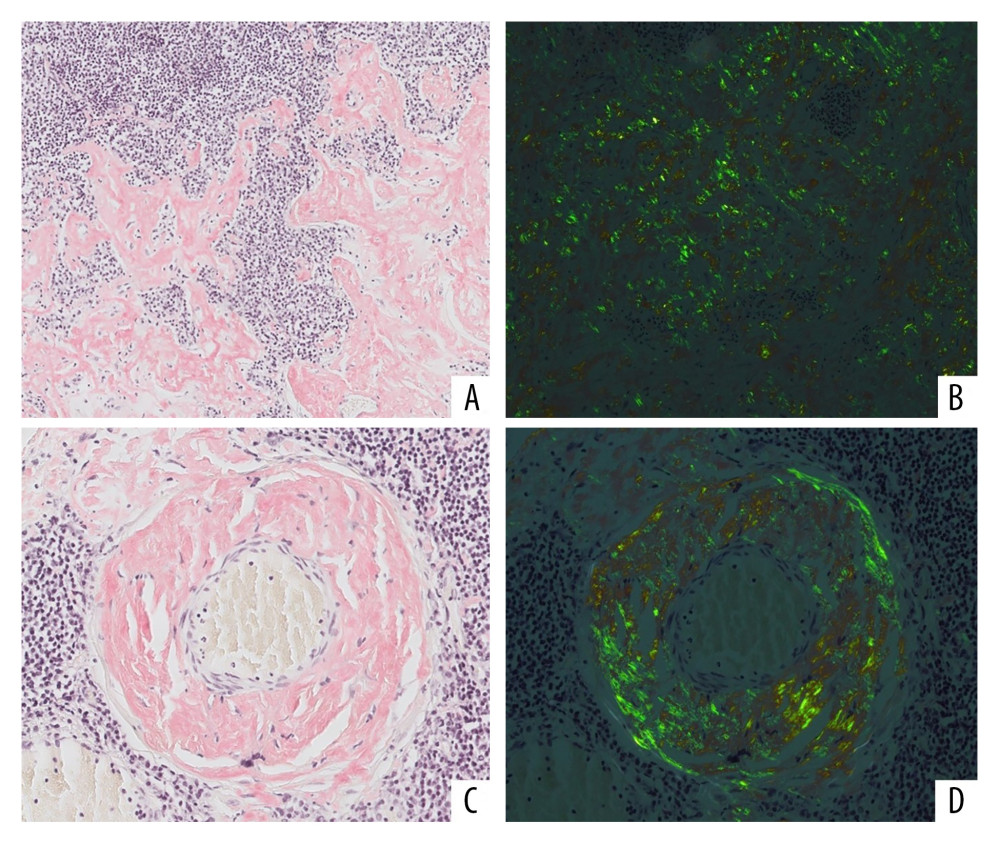 Congo red stain confirming the presence of a nodular, tumor-like deposit of amyloid (amyloidoma). The glassy extracellular material brightly stains with Congo red: it is intimately admixed with the lymphoplasmacytic population (A: ×100) and also thickens the vessel walls (C: ×100). The typical apple-green birefringence under polarized light confirms this is amyloid (B, D: ×100).