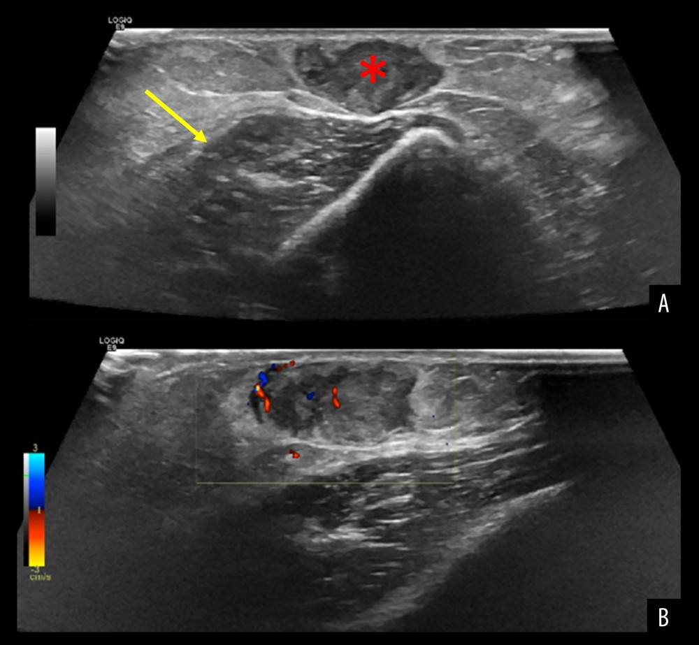 Ultrasound study of the elbow lesion at 1-month follow-up after the first excision. A first amorphous, band-shaped hypoechogenic zone without vascularization can be recognized, and interpreted as postoperative changes (arrow). Next to it, the clinically relevant, palpable subcutaneous nodule corresponds to a hypoechogenic soft-tissue mass measuring 1.4×0.8 cm (asterisk) and showing focal vascularization in Doppler study, thus warranting further investigation and removal for histopathological evaluation (A: B-mode; B: Doppler study).
