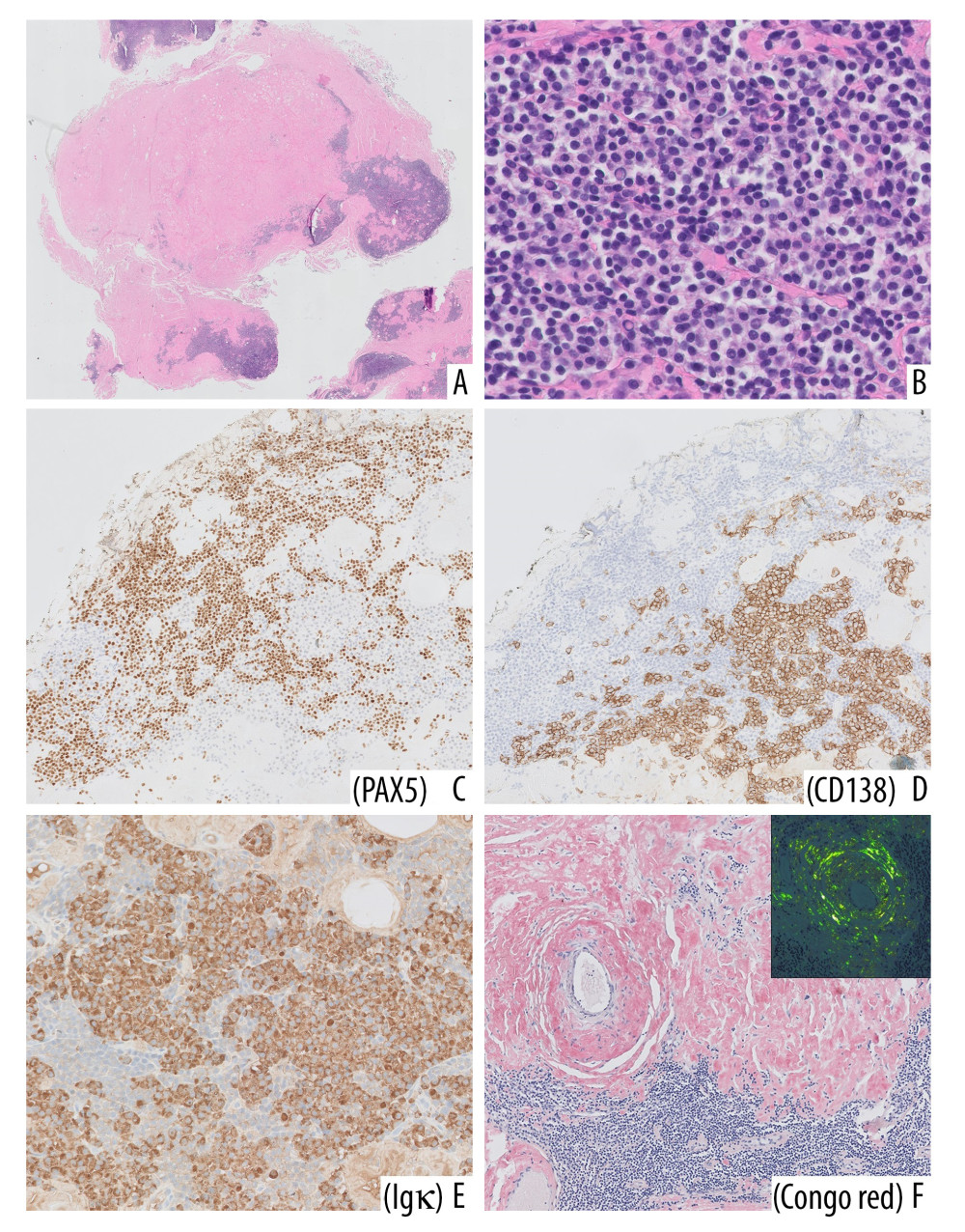 Histological and immunohistochemical features of the second excised elbow lesion. Even at low-power overview, the histopathological picture of the second sample (A: H&E ×50) clearly overlaps with that of the previously excised nodule, showing the tumor-like deposit of glassy pink amorphous material admixed with and focally overgrowing a lymphoplasmacytic infiltrate composed of small lymphocytes, plasma cells, and plasmacytoid lymphocytes, with numerous Dutcher bodies (B: H&E ×200). By immunohistochemistry, numerous PAX5+ B cells (C: PAX5 IHC ×100) are found in association with CD138+ plasmacytic cells (D: CD138 IHC ×100), and both cellular populations demonstrate Ig κ light-chain restriction (E: Ig k IHC ×200). As in the previous biopsy, the positivity for Congo red stain (F: ×100) and related apple-green birefringence under polarized light (inset: ×200) confirms the material is indeed amyloid.