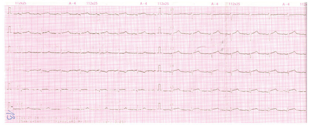 ECG (Electrocardiography) examination of a patient after admission to the Pregnancy Pathology Unit.