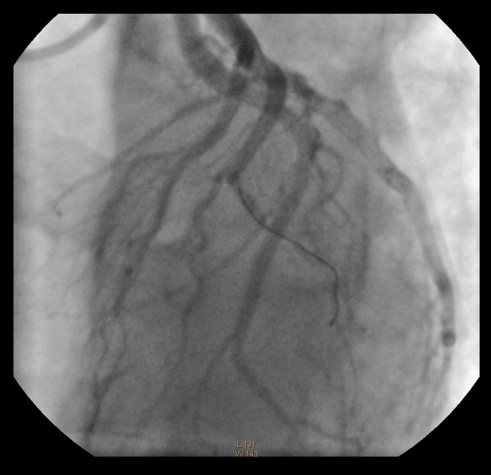 Angiogram of the left coronary artery in left anterior oblique projection with cephalic deflection. A well-contrasted septal branch can be seen, the anterior descending branch terminates before the apex. A strong diagonal branch closed in the middle segment. Angioplasty guidewire is visible in the lumen of the diagonal branch.