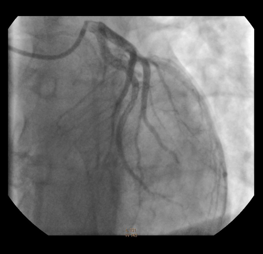 Angiogram of the left coronary artery in anteroposterior view with cephalic deflection. Very well-contrasted septal branch giving off a number of branches to the interventricular septum. The anterior descending branch is narrow, terminating at the apex of the heart. A second diagonal branch closed in the middle segment is visible.