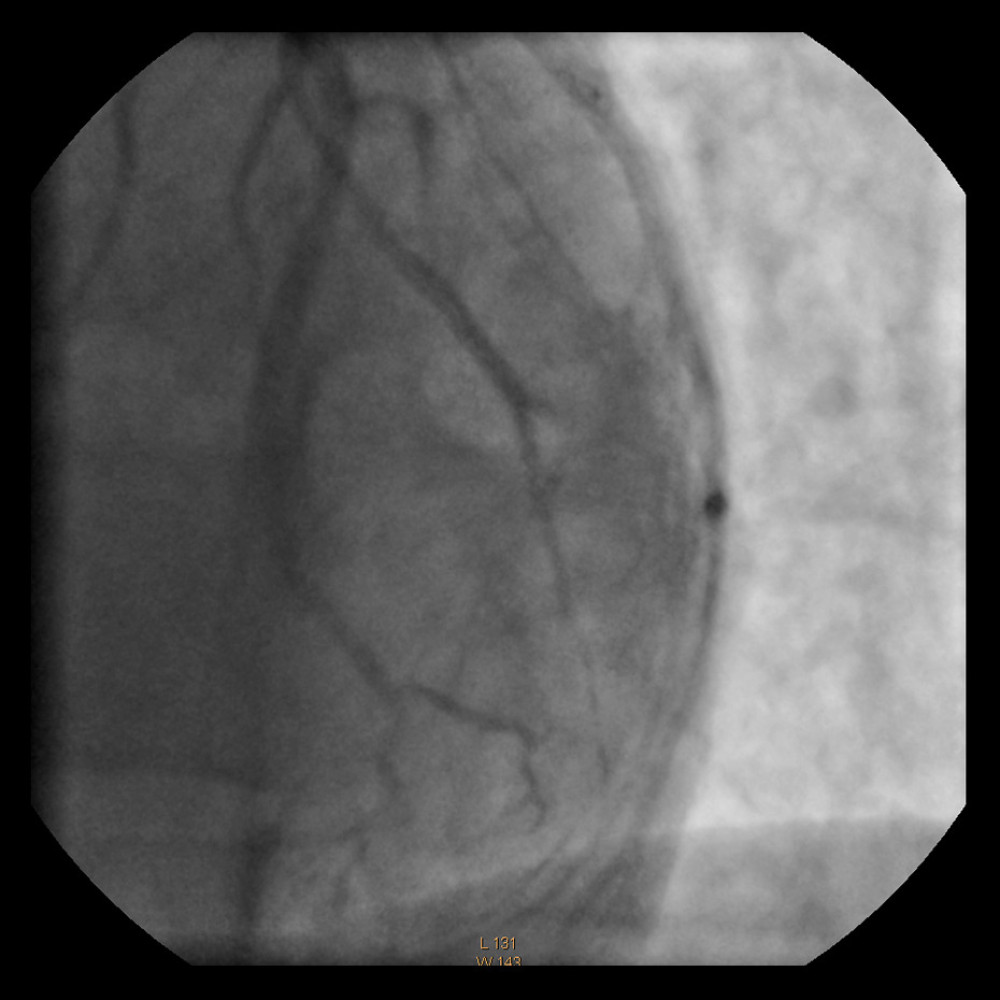 Angiogram of the left coronary artery in the left anterior oblique view with cephalic deflection. The visible effect of PCI (percutaneous coronary interventions)-improved second diagonal branch dividing into 2 branches in its middle segment. A stent implanted in the middle segment of the vessel is visible.