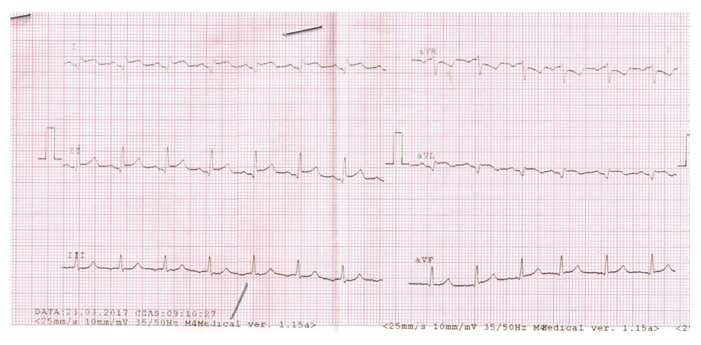 ECG (Electrocardiogram) recording 10 hours after PCI (percutaneous coronary interventions), limb leads.