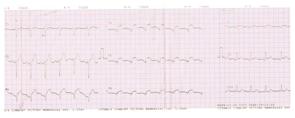 ECG (Electrocardiogram) recording 10 hours after PCI (percutaneous coronary interventions), pre-cardiac leads.