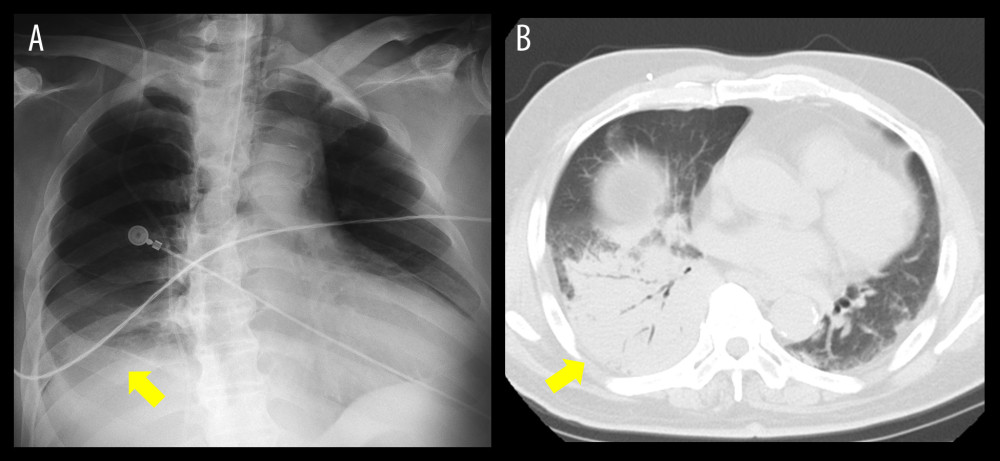 Radiologic findings on chest radiography and computed tomography. (A) Chest radiograph displaying decreased permeability of the right lower lung field (arrow). (B) Chest computed tomography scan showing significant consolidation with an air bronchogram occupying the right lobe (arrow).