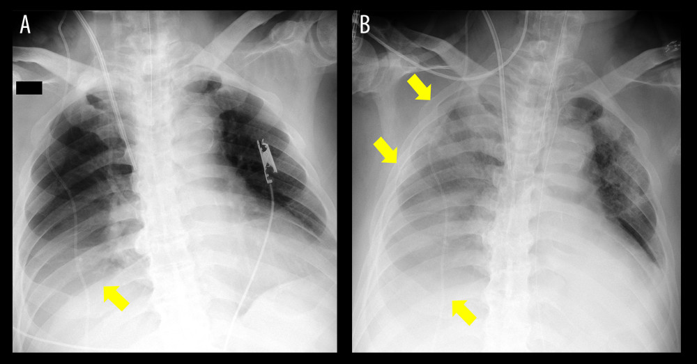 Timeline changes in the radiographic findings on chest radiography. (A – Day 3, and B – Day 5) Worsening consolidation in the right middle and upper regions.