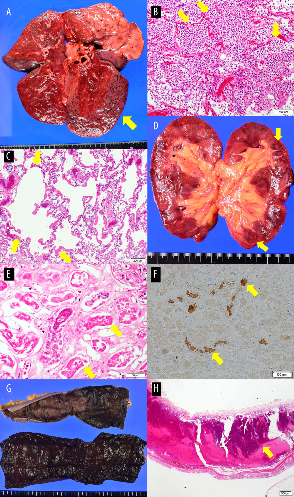 Findings from the autopsy of the lung, kidney, and small and large intestines. (A) Lung showing massive consolidation in the right lower lobe (arrow). (B) Neutrophil cell infiltration within the alveoli observed in the right lower lobe (arrow). (C) Enlargement of the alveolar space and hyaline membrane formation in the upper right lobe (arrow). (D) Clear border between the pale renal cortex and the congestion in the medullary region (arrow). (E) Tubular epithelial cell desquamation and casts observed (arrow). (F) Immunohistological study using an anti-myoglobin antibody showing myoglobin casts in the distal tubules (arrow). (G) The entire lumen of the small and large intestines showing hemorrhagic necrosis. (H) The small intestine showing diffuse submucosal hemorrhage and nonobstructive mesenteric insufficiency (arrow).