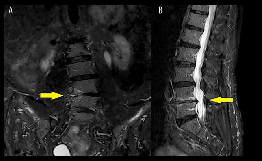 (A) Coronal and (B) sagittal magnetic resonance T2-weighted image 2.5 years after the spinal cord injury. The arrow shows the focal hypersignal.