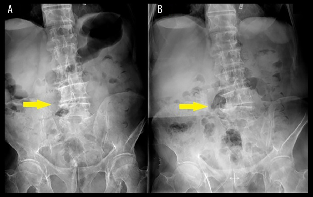 Frontal radiograph (A) 1.5 years after spinal cord injury and (B) 2.5 years after spinal cord injury. The arrow shows the evolution of the Charcot spine.