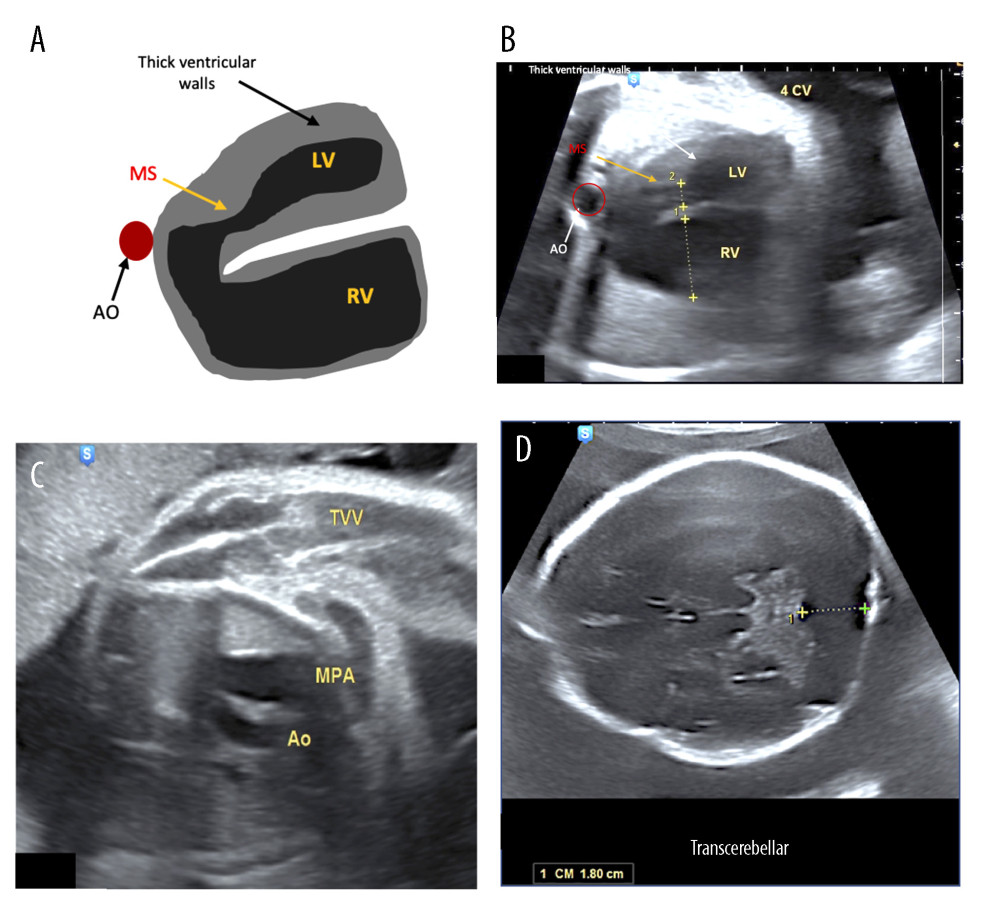 (A–D) Case 1. At level 4CV, the RV appeared to be much larger in volume compared with the LV. The mitral valve was in a state of mitral stenosis, and there was severe tricuspid regurgitation. At the TVV level, the diameter of the aorta appeared to be smaller than that of the main pulmonary artery. At the transcerebellar plane, a cisterna magna with a size of 1.8 cm is apparent. LV – left ventricle; RV – right ventricle; MS – mitral stenosis; MPA – main pulmonary artery; Ao – aorta; 4CV – 4-chamber view; TVV – 3-vessels view.