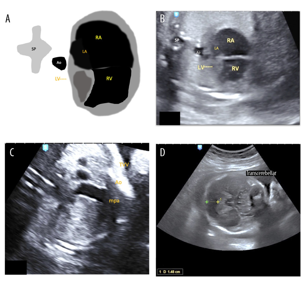 (A–D) Case 2. At the 4CV level, it appears that the LA and LV were very small; almost imperceptible, while in the TVV plane it appeared that the aorta was narrower than the main pulmonary artery, and the cisterna magna size was above normal, which is 1.48 cm. SP – spine; Ao – aorta; LA – left atrium; LV – left ventricle; RA – right atrium; RV – right ventricle; MPA – main pulmonary artery.