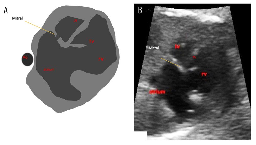 (A, B) Case 3. At level 4CV, the LV was still visible, with mitral valve stenosis, and the tricuspid valve exhibited tricuspid regurgitation. The diameter of the aorta looked small and “tiny” due to the lack of blood flow. It was evident that the 2 atria had united into a uniatrial structure. Ao – aorta; LV – left ventricle; RV – right ventricle; TV – tricuspid valve.