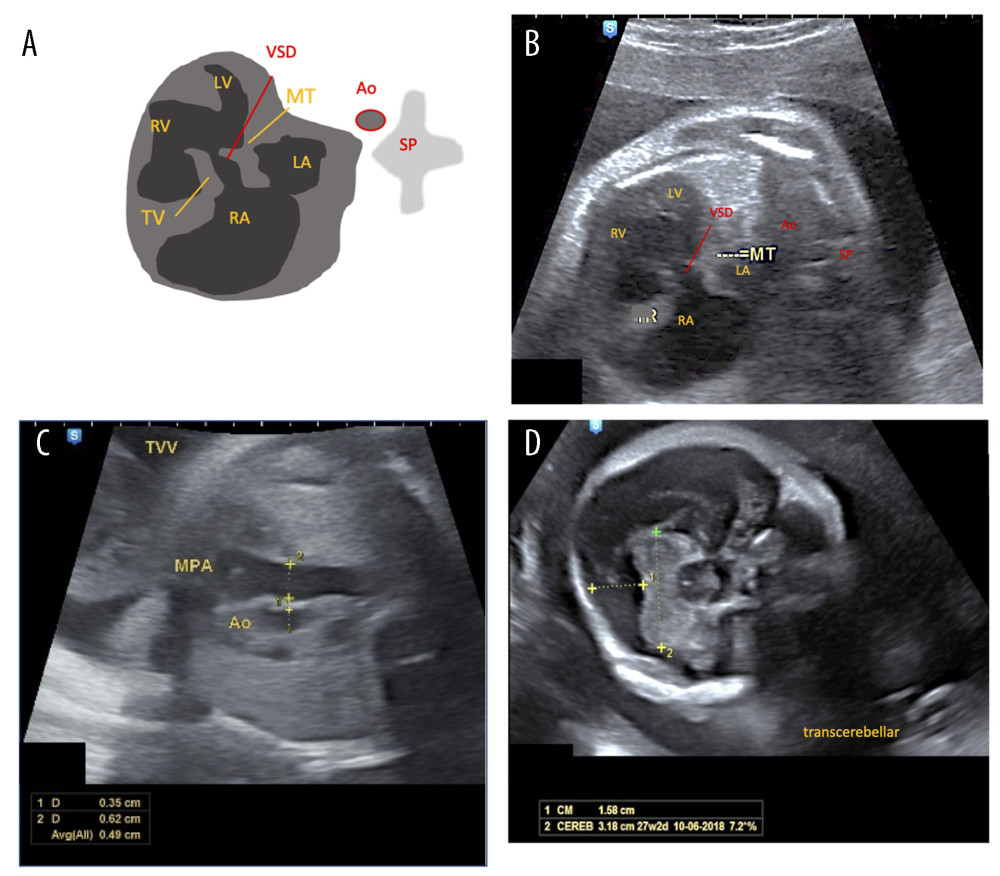 (A–D) Case 4. On the 4CV plane, the LV showed visible mitral stenosis, with a VSD and visible tricuspid regurgitation. The diameter of the aorta looked small and “tiny” due to the lack of blood flow. The 2 atria had nearly united. TVV footage showed an aorta that was smaller than the main pulmonary artery. In the transcerebellar plane, the shape of the head appeared abnormal, with the cisterna magna size showing 1.58 cm. SP – spine; Ao – aorta; LV – left ventricle; LA – left atrium; RV – right ventricle; RA – right atrium; VSD – ventricular septal defect; TV – tricuspid valve; MT – mitral valve; CM – cisterna magna; Cereb – cerebellum.