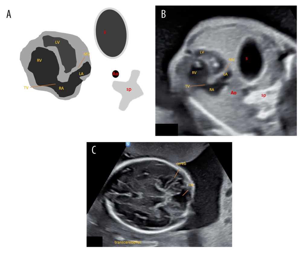 (A–C) Case 5. This is a case of HLHS in the context of congenital diaphragmatic hernia. Seen at the level of 4CV, the size of the LV is narrower when compared with the RV. The mitral valve had undergone severe stenosis and the tricuspid valve was in a regurgitated state. The 2 atria have fused. The stomach in the thoracic cavity is next to the heart. In this case, abnormalities in the cerebellum shape accompanied by dilation of the cisterna magna indicate a Dandy-Walker malformation or posterior fossa abnormality. LV – left ventricle; RV – right ventricle; LA – left atrium; RA – right atrium; TV – tricuspid valve; MT – mitral valve; CM – cisterna magna; cereb – cerebellum; Ao – aorta; Sp – spine; S – stomach.