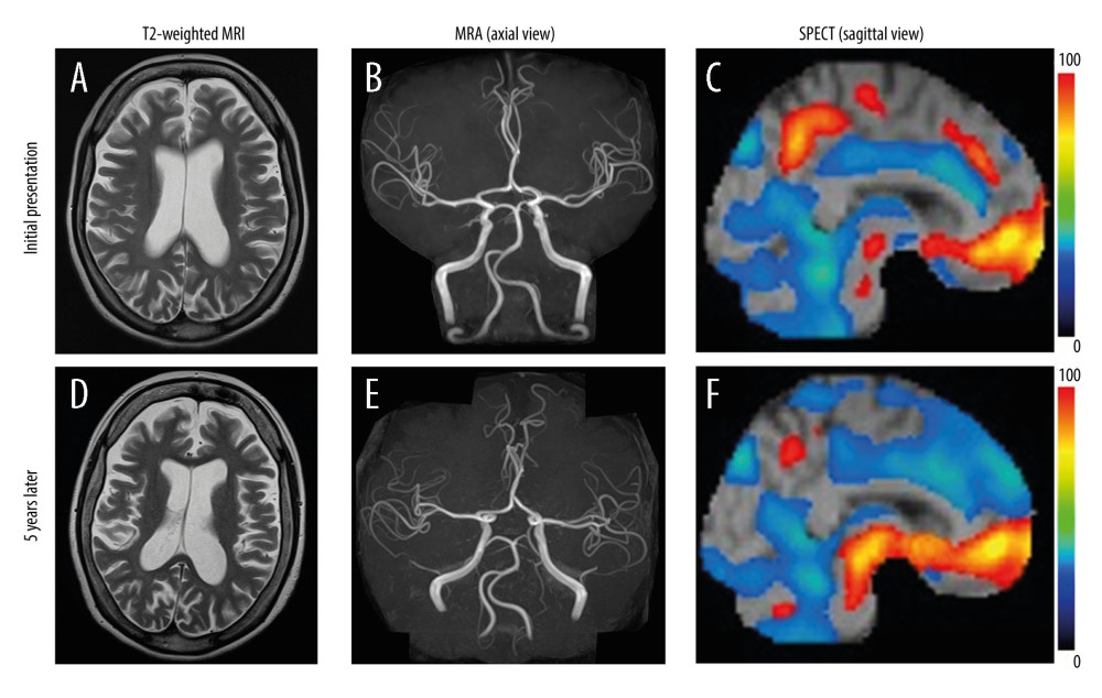 Comparison of magnetic resonance imaging and single-photon emission computed tomography/computed tomography (SPECT/CT) findings of the brain at admission and 5 years later. (A, D) T2-weighted image, axial view. In this sequence, hemorrhages and hemosiderin deposits are hypointense. (A) Severe global brain atrophy can be seen at admission. (D) The atrophy has progressed significantly 5 years later. (B, E) Magnetic resonance angiography (MRA), axial view. MRA is used to detect narrowing of the arteries and to rule out aneurysms. No stenosis was seen in the brain vessels at either admission or 5 years later. (C, F) SPECT/CT, sagittal view. A SPECT/CT scan was used to visualize how blood flows through the arteries and veins in the brain. Red color indicates areas of rich blood flow, and blue color indicates areas of low blood flow. (C) The findings at admission show a reduction in the blood flow throughout the whole brain and especially in the bilateral frontal, temporal, and parietal lobes. (F) Five years later, the cerebral blood flow in the cranial occipital lobe was further reduced, compared with that upon initial presentation.