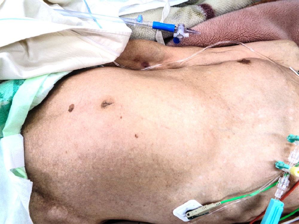Photograph of the abdomen on arrival at the hospital: Note prominent abdominal distention extending from the pericardium to the lower abdomen.