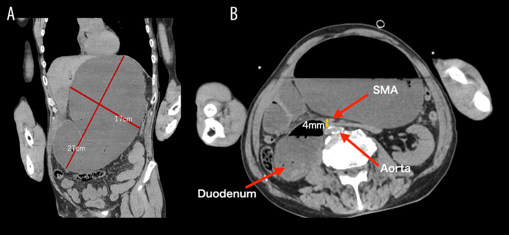 Simple CT scan findings on arrival at the hospital: (A) The massive gastric dilatation (red line). (B) The duodenum is compressed by the superior mesentery artery and aorta. The distance between the aorta and SMA is 4 mm (yellow line).