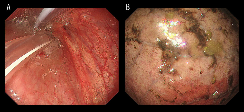 Endoscopic findings: (A) The cardia is stenosed and the previously inserted gastric tube is folded back. (B) The gastric mucosa is pale, suggesting ischemia.