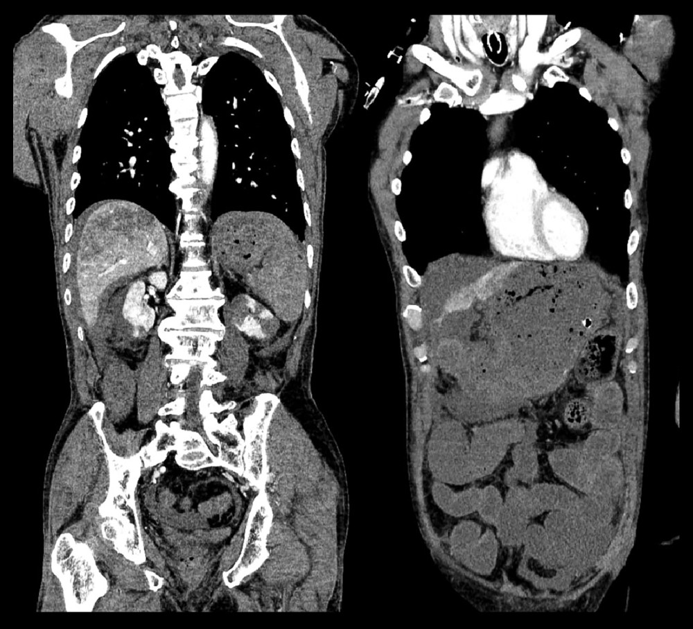 Contrast-enhanced CT scan findings on day 2 of hospitalization: Contrast defects are observed in the stomach, small and large intestines, liver, kidney, and spleen.