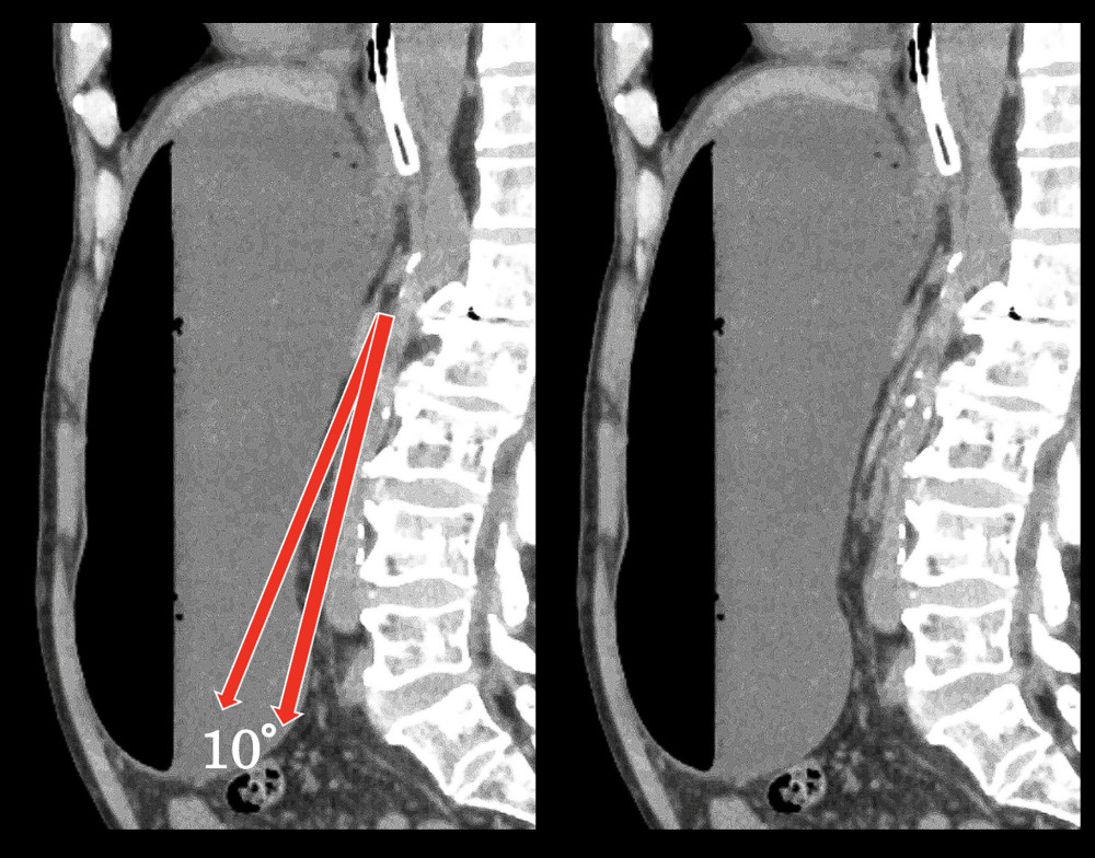 Before decompression: The angle of the aortic superior mesenteric artery.