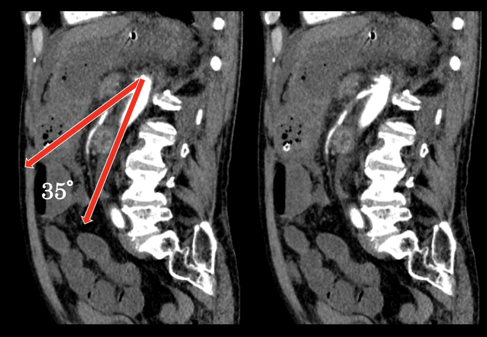 After decompression: The angle of the aortic superior mesenteric artery.