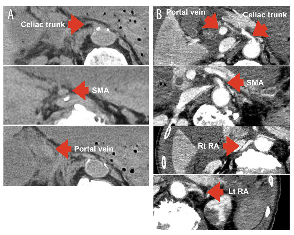 (A) Before decompression: Plain computed tomography (CT) showing compression of the celiac artery, SMA, and portal vein by the stomach and duodenum. (B) After decompression: Contrast-enhanced CT showing contrast enhancement of the celiac artery, SMA, portal vein, and right (Rt) and left (Lt) renal arteries (RA).