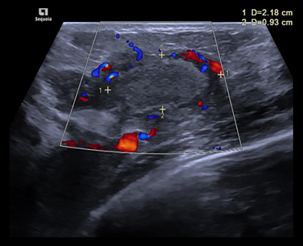 Ultrasound of the left breast revealing a speculated rounded lesion.