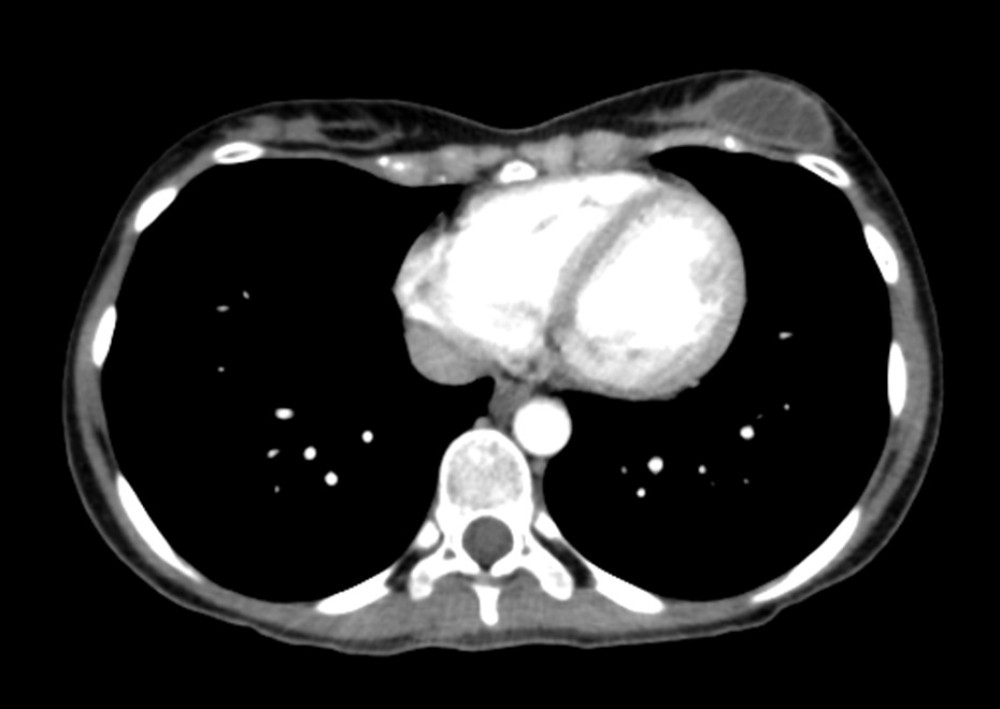 Thoracic CT revealing multiple well-defined enhancing outlines in keeping with breast granulomatous disease.