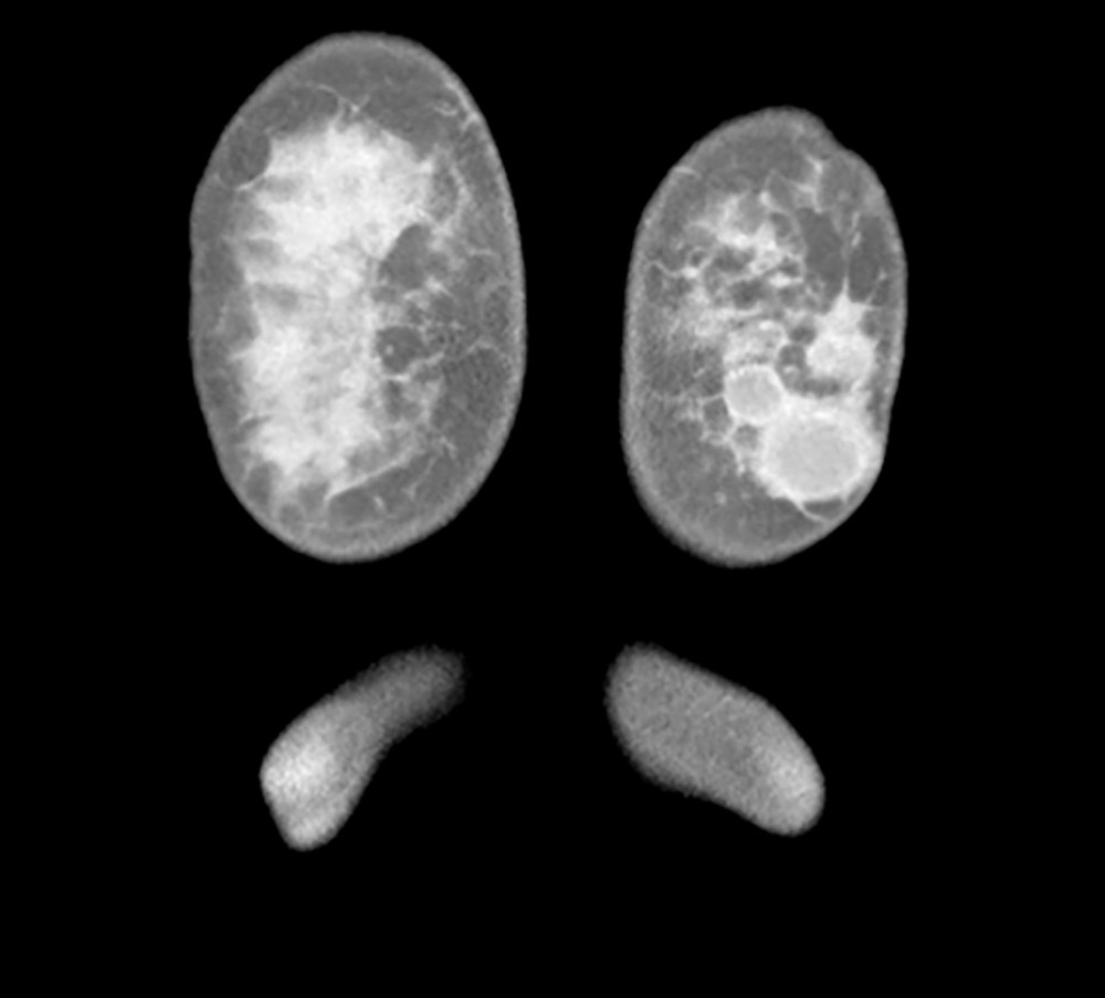 CT illustrating a well-defined masses in the left breast.