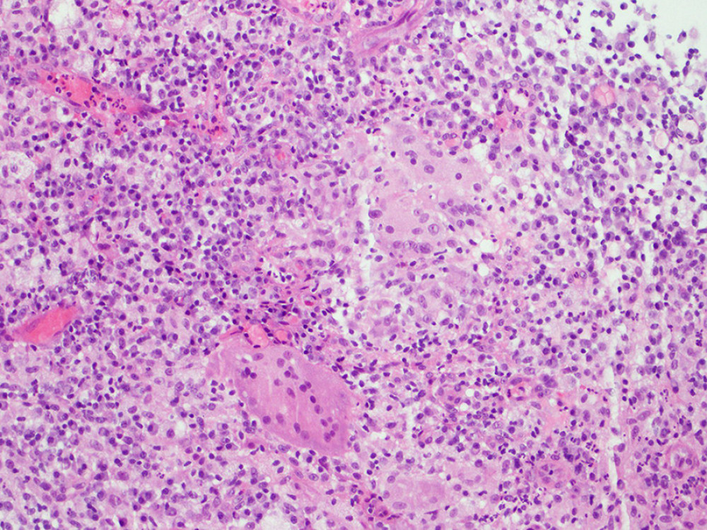 Histologic section showing non-caseating granulomas.