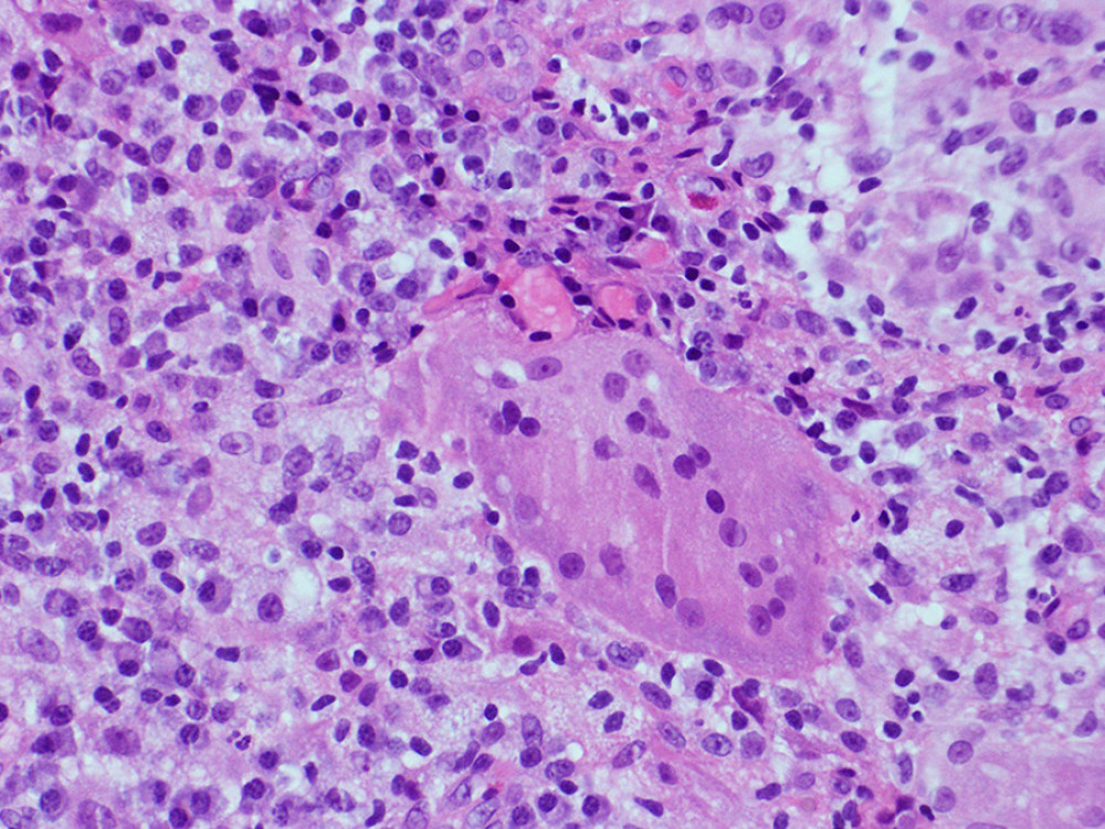 High-power image showing chronic inflammation with giant cells.