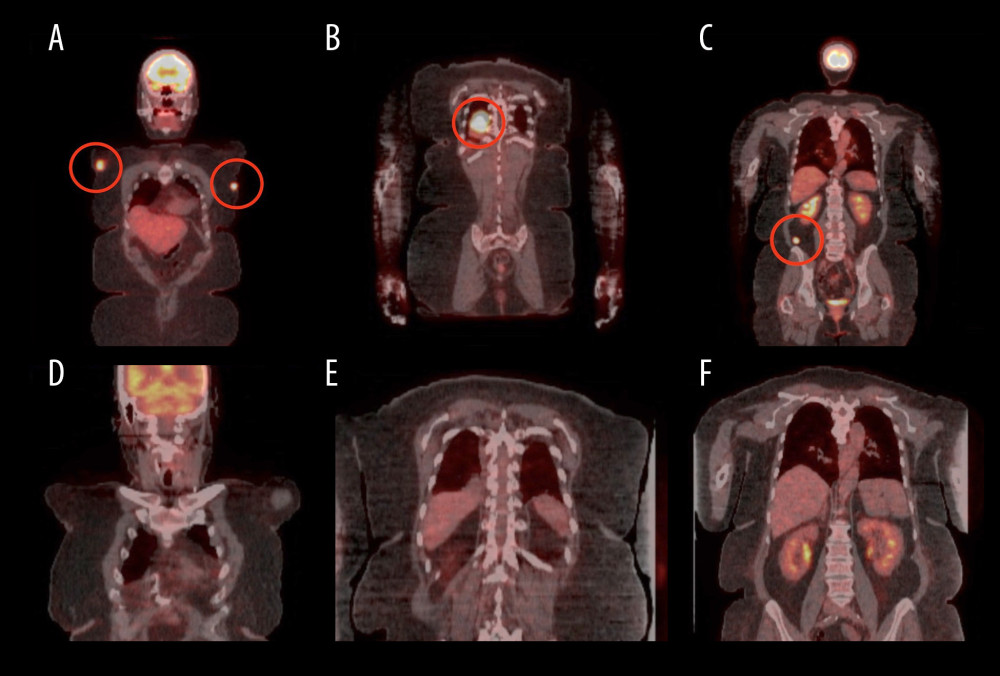 Images (A–C) show the initial positron emission tomography-computed tomography scan before treatment. The soft tissue masses in the right and left chest wall, the right lower lobe lung mass, and the lobular mass in the right abdomen are marked with red circles. Images (D–F) show the complete metabolic response at all disease sites.