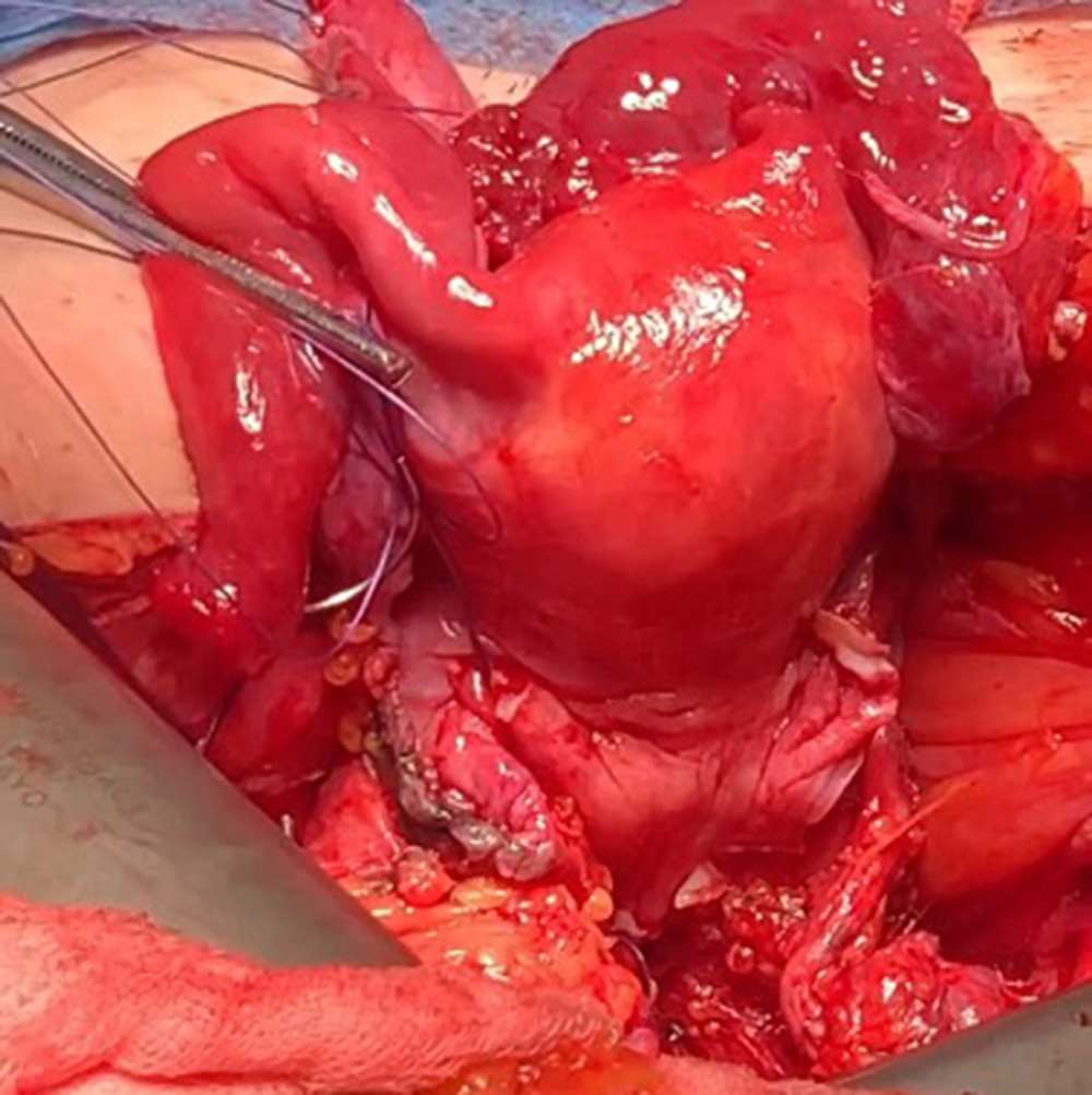 Transplanted uterus showing regular vascularization of the graft.