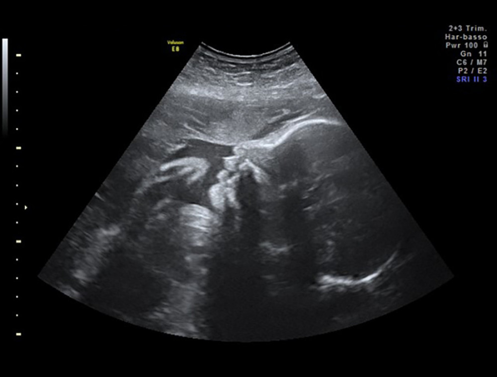Fetal profile ultrasound at week 30: Third trimester ultrasound revealed regular fetal development.
